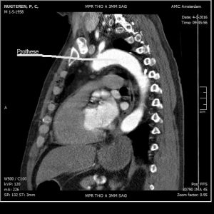  Na de operatie vanwege aortadissectie, met aortaprothese.