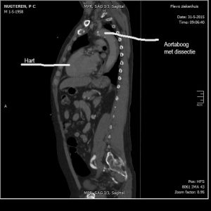 CT scan na de aortadissectie, vòòr de operatie