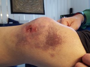 knie dik